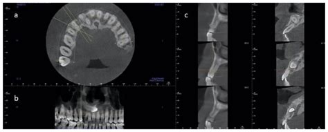 Materials Free Full Text Immediate Post Extraction Short Implant