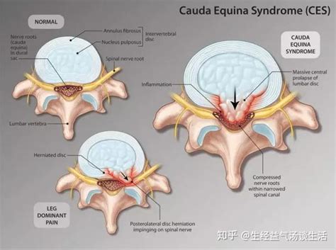 腰椎间盘突出症有必要清楚马尾神经综合征的严重危害 知乎