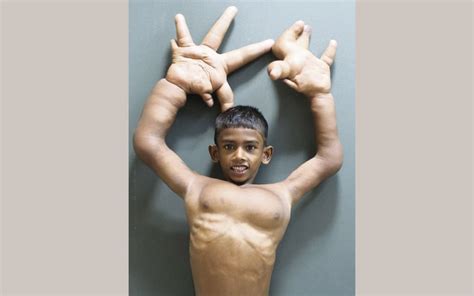 Hope For Indian Boy With The Worlds Biggest Hands
