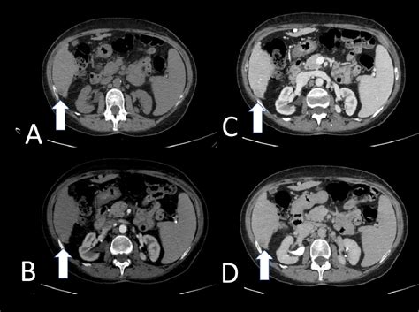 Figure 1 From Hcc Diagnosis Is Li Rads Reporting System The Best