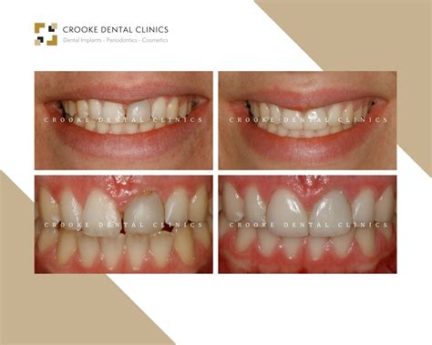 Gum Recontouring And Left Incisor Crown Crooke Dental Clinic