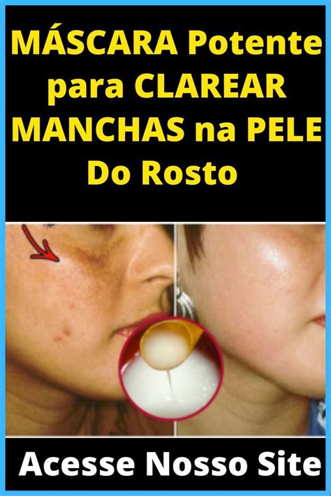 Como Clarear Manchas Na Pele - CLIQUE AQUI P/ DESCOBRIR a MÁSCARA Potente para CLAREAR MANCHAS na PELE ...