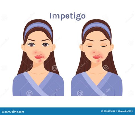 Isolated Cute Cartoon Brunette Woman With Impetigo Beautiful Face