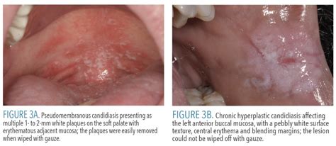 1020-mucosal-lesions-3 - Dimensions of Dental Hygiene | Magazine