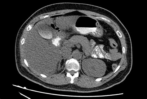 Perforated Duodenal Ulcer Image