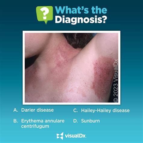 What’s causing this girl’s rash? Take the quiz. | VisualDx