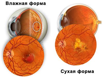 Лечение сухой формы макулодистрофии - клиника "Clean View"