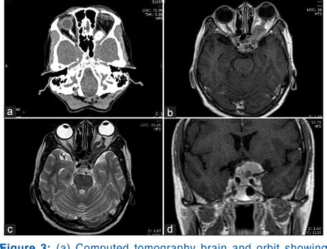 Figure From A Rare Case Of Bilateral Optic Nerve Sheath Meningioma