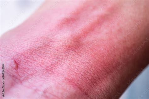 skin allergy with rash after mosquito bite Stock Photo | Adobe Stock