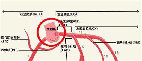 人工血管置換術 ～大動脈基部置換術の術後看護～｜看護師うめブログ
