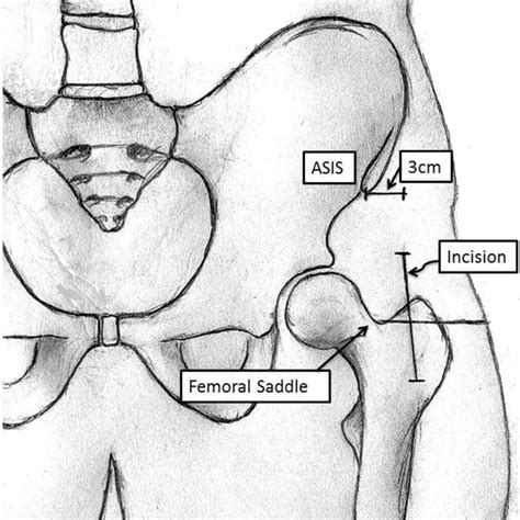 Pdf Saddle To Incision Relationship A Novel Approach To Localizing The Incision For Direct