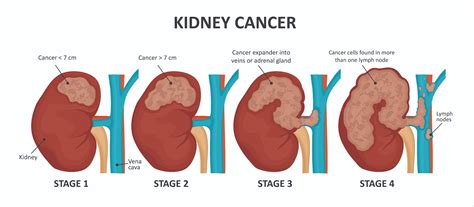 Kanker Ginjal Ginjal Tanda Diagnosis And Perawatan Di Singapura