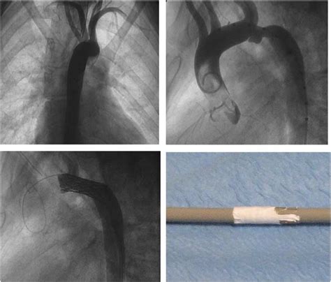 Right Upper Ascending Aortography In Anteroposterior View Showing