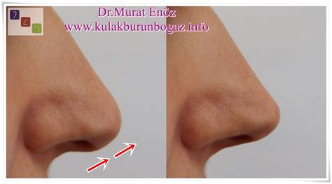 Droopy Nose Tip Causes And Treatment