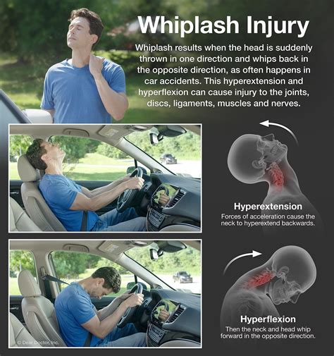 Whiplash Injury On Nerves