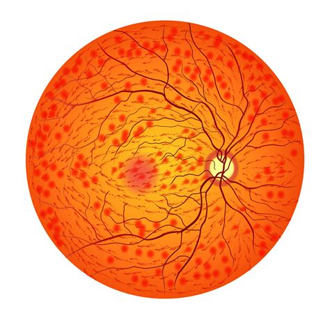 Central Retinal Vein Occlusion (CRVO) - Dr Rehman Siddiqui