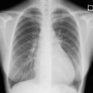 Transthoracic Echocardiogram At The Initial Visit A Parasternal Left