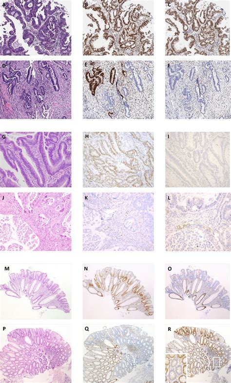 Inter Tumoral Mismatch Repair Mmr Protein Immunohistochemistry Ihc Download Scientific