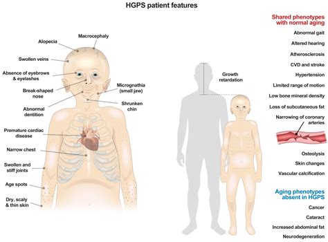 Cells Free Full Text Metabolic Dysfunction In HutchinsonGilford