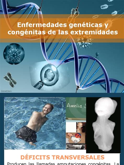 Enfermedades Genéticas Y Congénitas De Las Extremidades Pdf