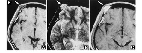 T 1 Weighted Magnetic Resonance MR Image A Showing The Lesion As