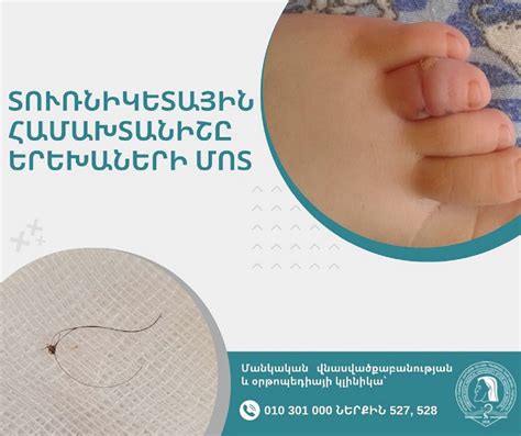 Տուռնիկետային համախտանիշը երեխաների մոտ. վտանգներից մինչև բուժում ...