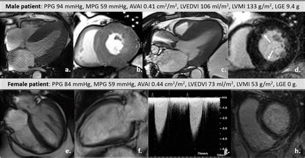 Sex Differences In Left Ventricular Remodelling Myocardial Fibrosis And Mortality After Aortic