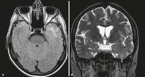 Hipersinal Em T2 E Flair - Foco De Hipersinal Em T2 E Flair - METOBRAIN