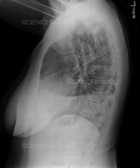 Pleural Effusion X Ray Stock Image Science Source Images