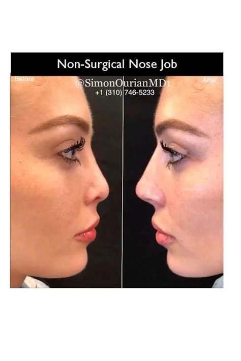 Nose Job Before And After By Dr Simon Ourian Artofit