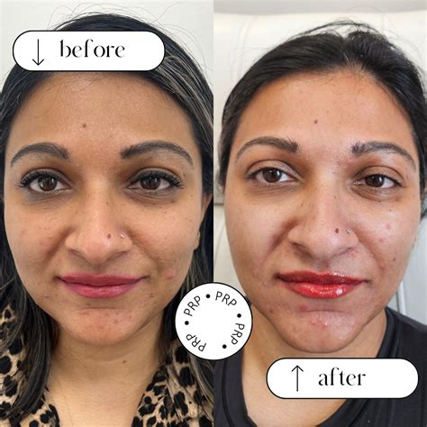 prp  eye treatment  niagara reduce dark circles puffiness