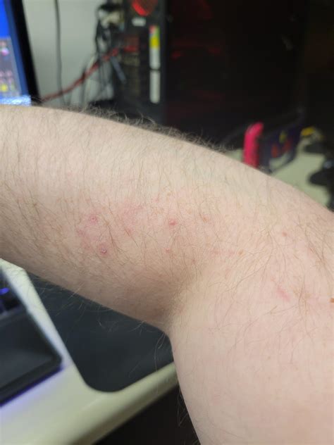 my arm has been itching for a month? haven't been around poison ivy or