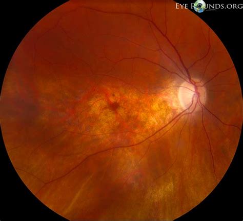 Atlas Entry - Chloroquine retinal toxicity