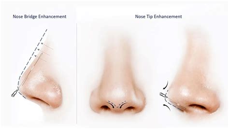 nose thread lift  malaysia  surgical nose enhancement hn clinic