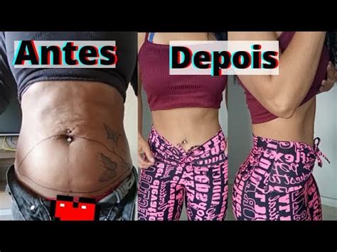 Lipoabnoplastia Antes E Depois