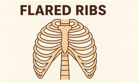 Flared Ribs: Causes, Symptoms, Treatment, and Prevention - Gessolini