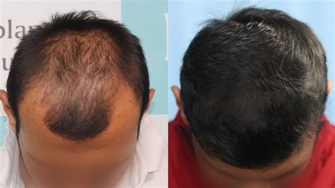 Best Hair Transplant Result 2021 Nw Grade Iii 3215 Grafts Regrow Clinic Haridwar Youtube