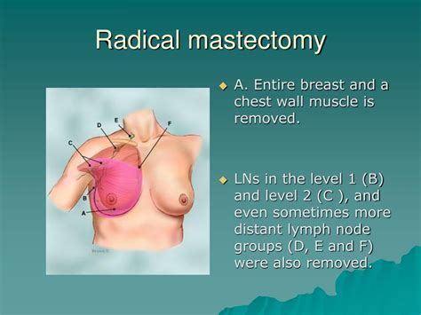 Ppt Breast Cancer Powerpoint Presentation Free Download Id 4807153