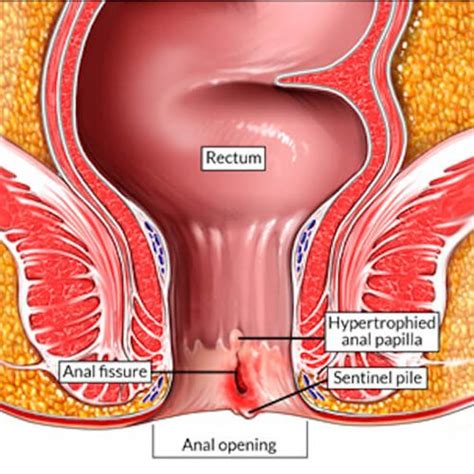 Fisura anal Gastro Cirugía Irapuato