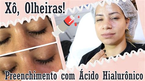 Antes X Depois Preenchimento De Olheiras Cido Hialur Nico