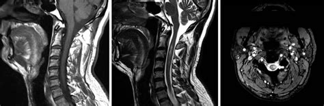 Understanding Transverse Myelitis - Medika Life : Patient Information Sheet