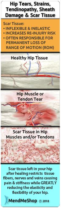 Popliteus Tendinitis: Symptoms, Causes, Diagnosis & Treatments