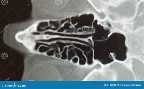 ct scan   ethmoid sinus air cells stock photo image  maze