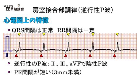 分かる！房室接合部調律の心電図 | こっそりEBM勉強会
