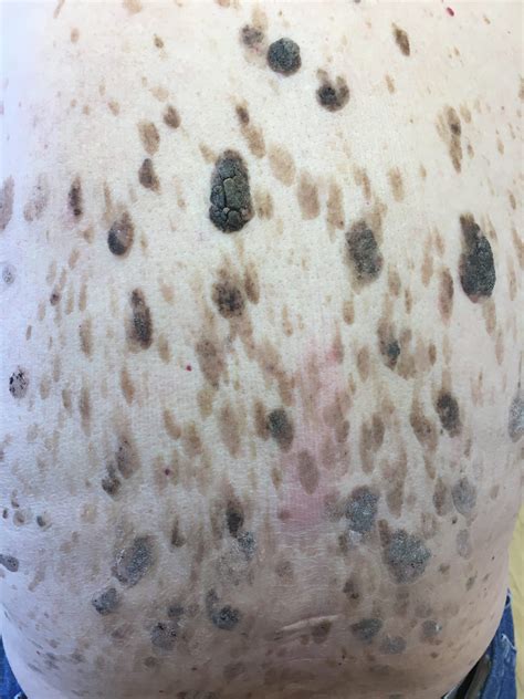 Seborrheic Keratoses - What Are They and What You Can Do About Them