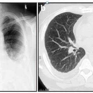 a Chest X-ray of the patient showing patchy perihilar infiltrates. b ...