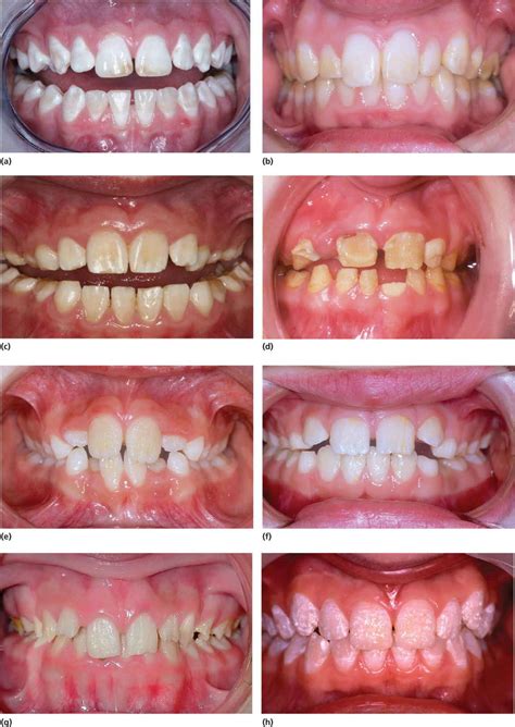 20 Developmental Defects Of The Dental Hard Tissues And Their