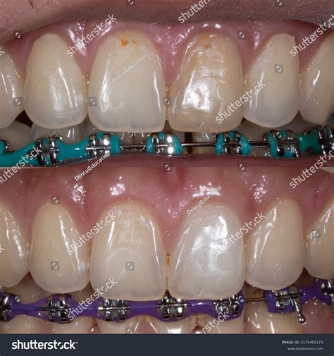 Before After Internal Bleaching Tooth Stock Photo 2175481173 | Shutterstock