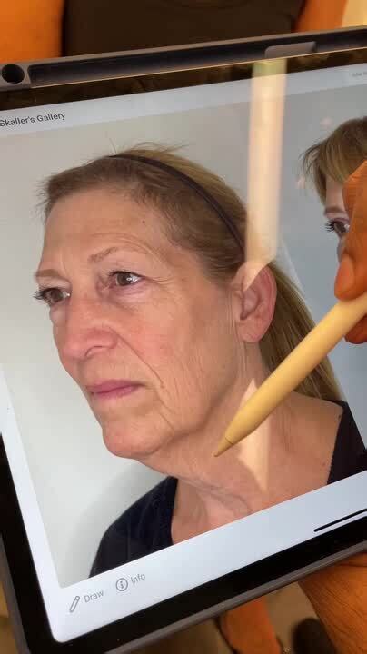 Months Out From Awake Deep Plane Facelift Extended Neck Lift Upper