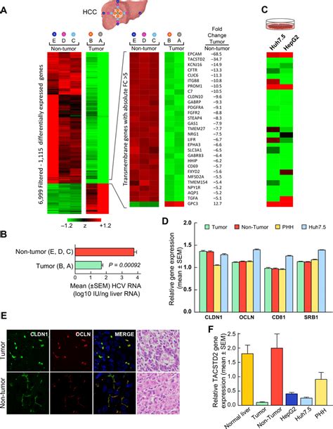 Gene Expression Profiling And Hcv Rna In Tumor And Nontumorous Liver Download Scientific